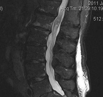 Ependymoma Conus MRI Sagittal